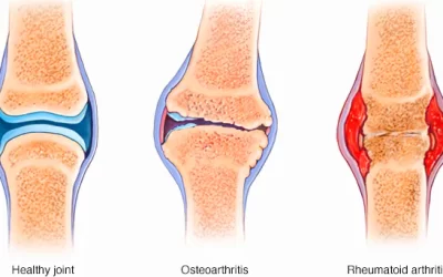 What Is Rheumatoid Arthritis? A Simple Explanation for Families and Individuals