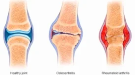 Healthy Joint vs Osteoarthritis vs Rheumatoid Arthritis